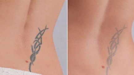 Cum și ce pentru a elimina un tatuaj Cum și ce pentru a elimina un tatuaj