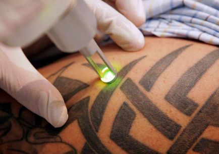Cum și ce pentru a elimina un tatuaj