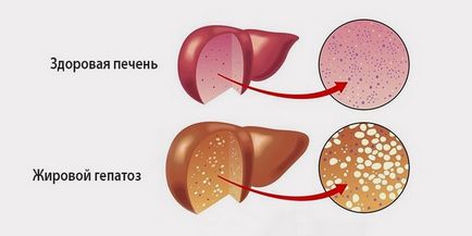 Ce este steatoza hepatică de tratament