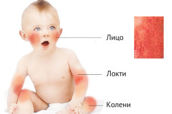 Alergia la simptomele de piele pentru copii și tratamentul de remedii populare și medicamente (video)