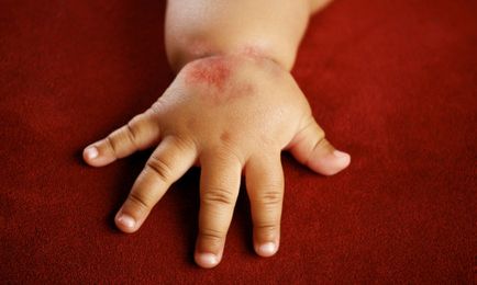 Alergia la simptomele de piele pentru copii și tratamentul de remedii populare și medicamente (video)