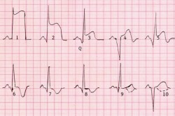 Tensiunea arterială în infarctul miocardic