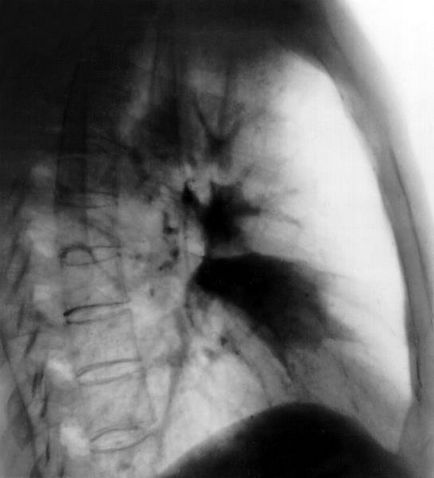 Atelectazie pulmonar - este