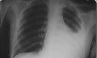 Atelectaziile pulmonar - cauze, simptome, diagnostic și tratament