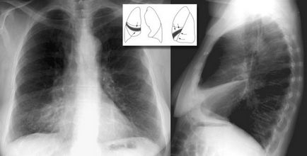 Cauzele atelectazie pulmonare, simptome, tratament