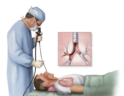 Cauzele atelectazie pulmonare, simptome, tratament