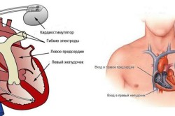 Blocada mănunchiului piciorului stâng al simptomelor și a tratamentului său