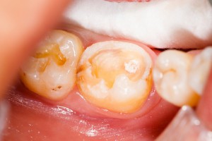 Toothache după cauzele de umplere și tratament