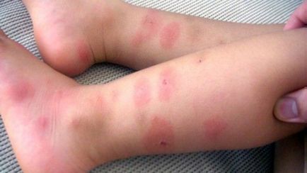 Bug-uri de pat sunt periculoase pentru consecințele umane ale mușcăturilor, și urme