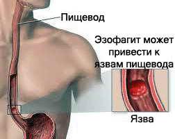 Simptomele esofagitei distale și tratament