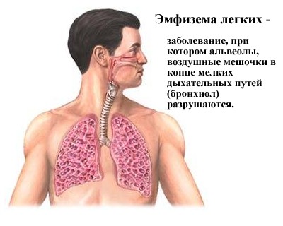 Cauzele emfizemul, semne, simptome, tratament