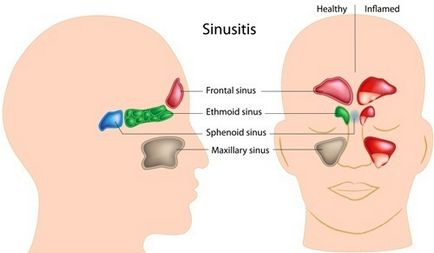 Simptomele Ethmoiditis și tratament