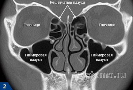 Ethmoiditis - simptome și tratament la adulți, antibiotice, picaturi