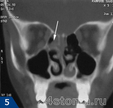 Ethmoiditis - simptome și tratament la adulți, antibiotice, picaturi