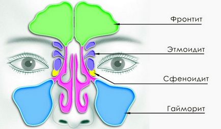 Tipuri de Ethmoiditis, cauze, semne, simptome, tratament