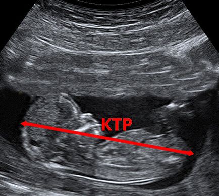 dimensiunea fetale Fetometry cu ultrasunete