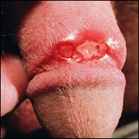 Genital herpes simptome, fotografie, tratament pentru bărbați și femei