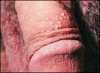 Genital herpes simptome, fotografie, tratament pentru bărbați și femei