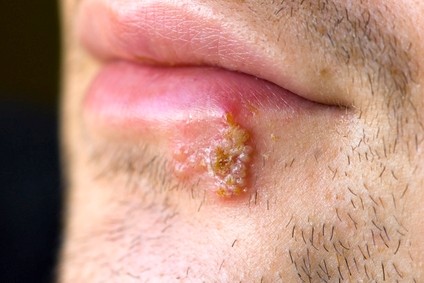 Herpes pe buze - cauze, semne, simptome, tratament