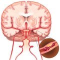 creier hidrocefalie tratament, simptome si cauze