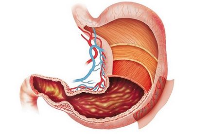 stomac Hiperemia ce este, mucoasa, arterială focală