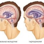 Hidrocefalie semne sindrom hipertensivă și tratamentul bolii smptomy