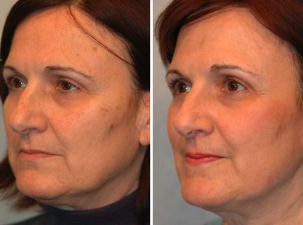 Coji de glycolic faciale la domiciliu, cum se face procedura