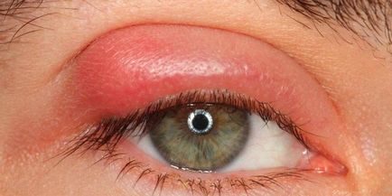 simptome viermilor oculari