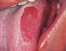 Glossalgia simptome, cauze si tratamente glossalgia limba