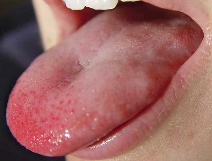 Glossalgia simptome, cauze si tratamente glossalgia limba