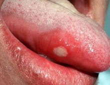 simptome glossalgia, cauze si tratamente glossalgia limbaj (metode) Glossalgia simptome, cauze si tratamente glossalgia limba