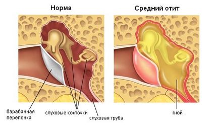 otita medie supurativă - cauze, simptome, simptome și tratament