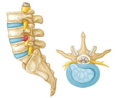 Hernia de tratament a coloanei vertebrale lombare, simptome