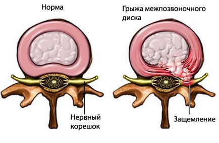 Herniate simptome coloanei cervicale, tratament