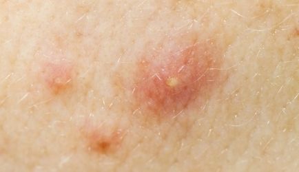 boli infecțioase ale pielii - tratament fotografie