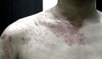 boli infecțioase ale pielii - tratament fotografie