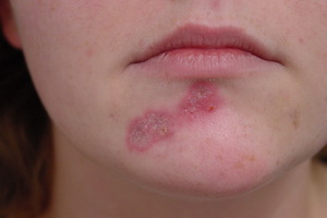 Boli infecțioase ale cauzelor pielii și a părului, simptome de infecții fungice ale pielii și