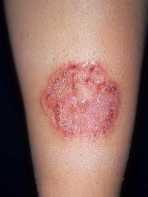 Boli infecțioase ale cauzelor pielii și a părului, simptome de infecții fungice ale pielii și