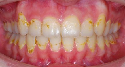Reimplantarea modul în care tratamentul ortodontic