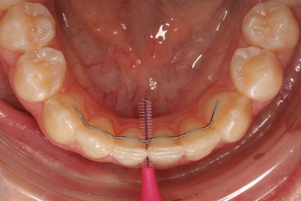 Reimplantarea modul în care tratamentul ortodontic