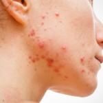 Cum de a elimina rapid acnee la rețete pentru acnee