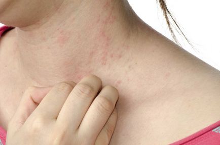 Cum de a distinge varicela de alergii