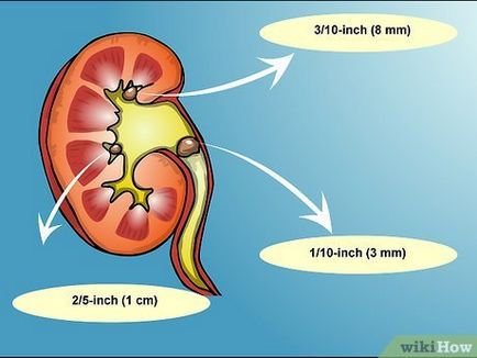 Cum să scapi de pietre la rinichi