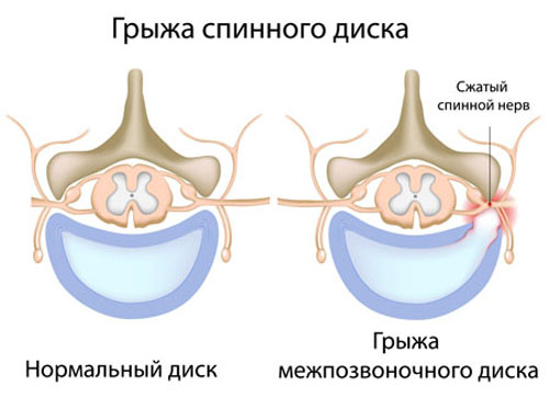 Cum de a trata hernie intervertebral la domiciliu