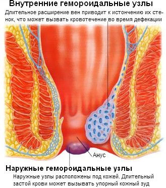 Cum de a trata remedii hemoroizi externe populare la domiciliu