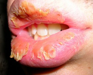 Cum de a trata cheilitei pe buzele cauzele și simptomele bolii