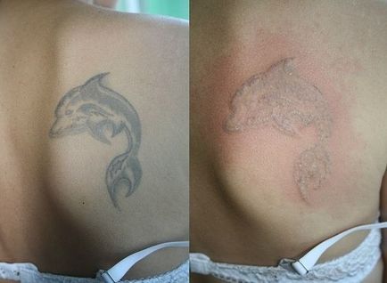 Cum sa faci un tatuaj acasa sau cu laser