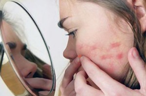 Cum de a elimina gropile de acnee pe fata