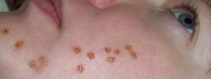 Cum de a reduce acnee - rapid, roșeață, pe noapte, inflamație, pe fata (noapte) Cum de a reduce acnee - rapid, roșeață, pe noapte, inflamație, facială