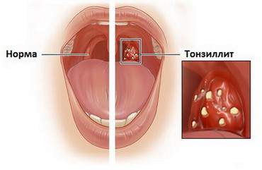 Cum de a alege produsele dintr-o durere în gât
